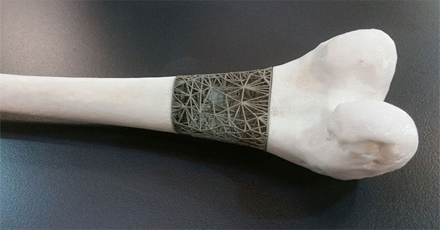 A woman implanted a spinal disc with 3D printing technology