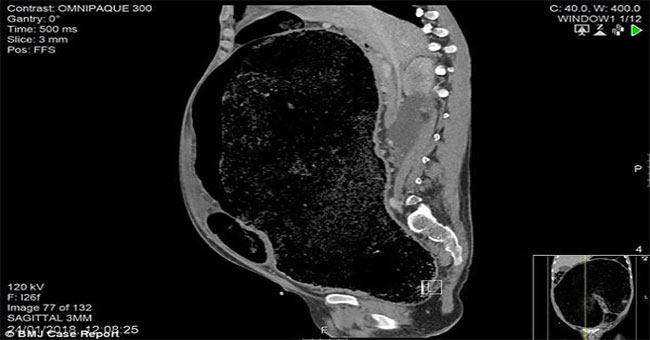 Abdominal pain, diarrhea for 1 week, the man almost lost his life due to colon