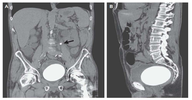 Abdominal pain, the man hospitalized for X-rays and obtained a frightening result