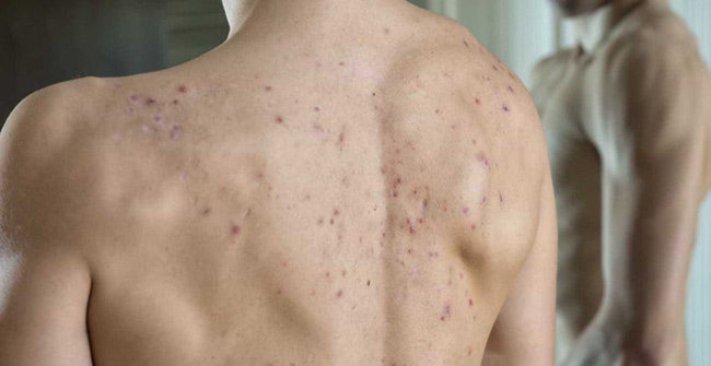 Acne on the back is a sign that the body is being made?