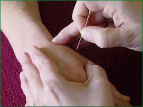 Acupuncture and massage help relieve pain after cancer surgery
