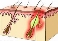 Acute folliculitis is common during the hot season