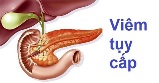 Acute pancreatitis: Symptoms, treatments and prevention