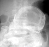Add one case of calcifying fetus for 40 years
