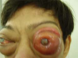 Alarm eye cancer