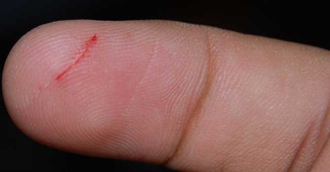 Alert the disease that causes death from 1 small scratch