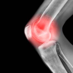 Allium, the active ingredient from garlic helps treat hip osteoarthritis