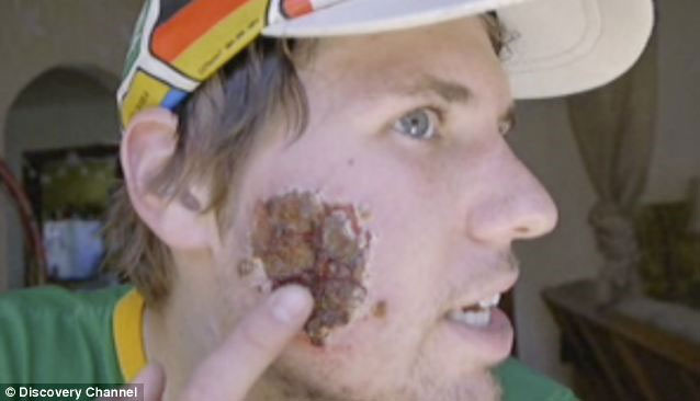Almost lost his life because the parasite eats meat
