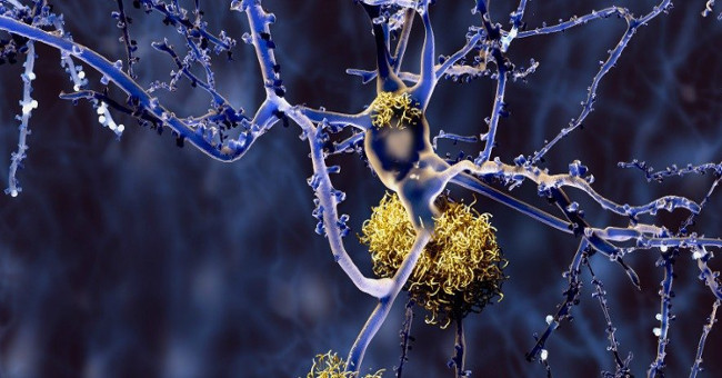 Alzheimer's also has many different types