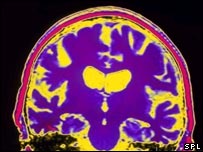 Alzheimer's disease after a century of discovery