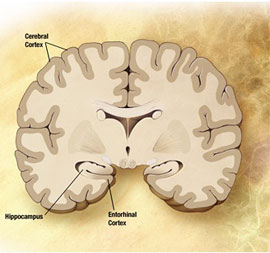 Alzheimer's disease is preventable