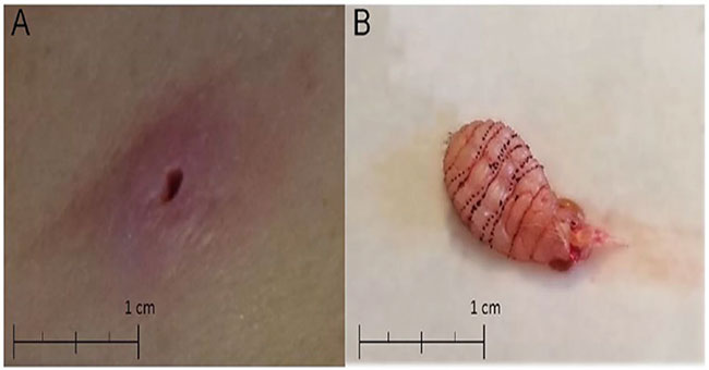 America: Detecting meat-eating maggots nesting in the legs because of insect bites