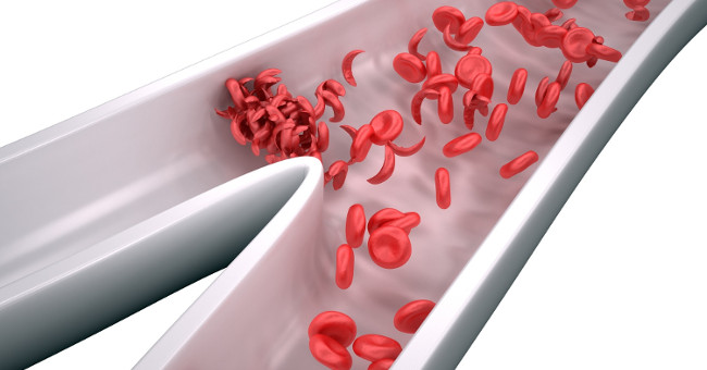 America develops sickle cell therapy
