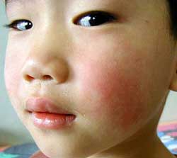 America: Outbreaks of mumps infection