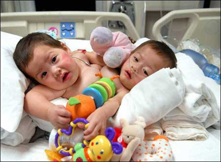 America: Successfully separated conjoined twins