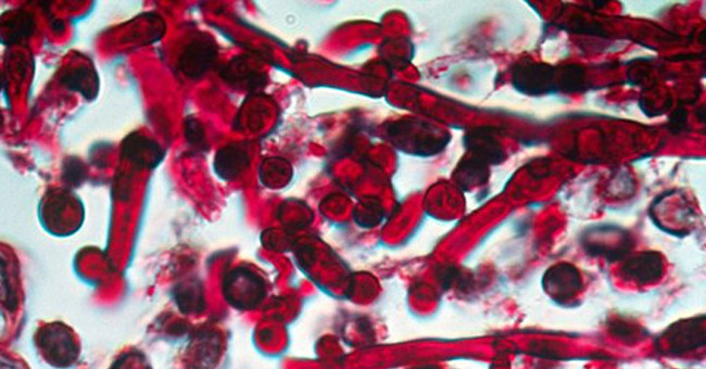 American doctors are concerned about a new deadly fungal infection strain