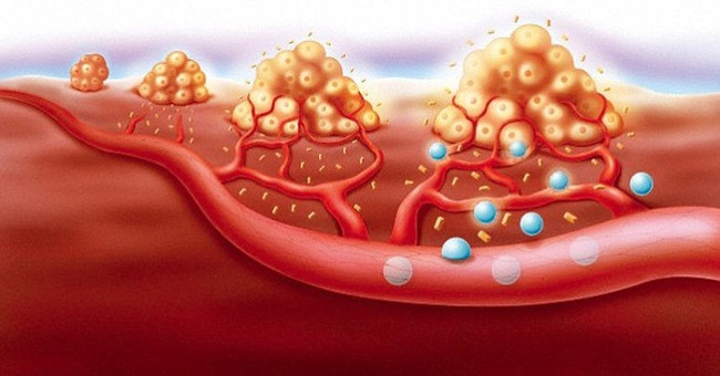 American scientists have found a way to prevent cancer from spread
