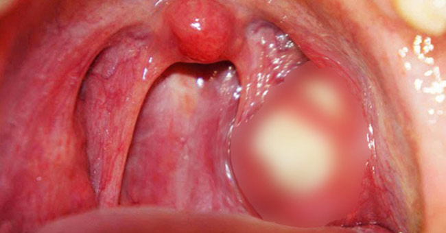 Ammonium stones are the main cause of your mouth stinking.