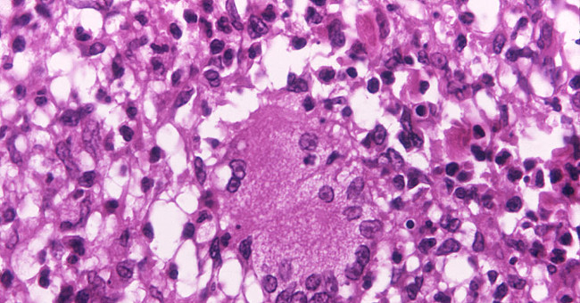 Ancient bacteria causing leprosy are mutating