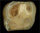 Ancient people also drilled teeth