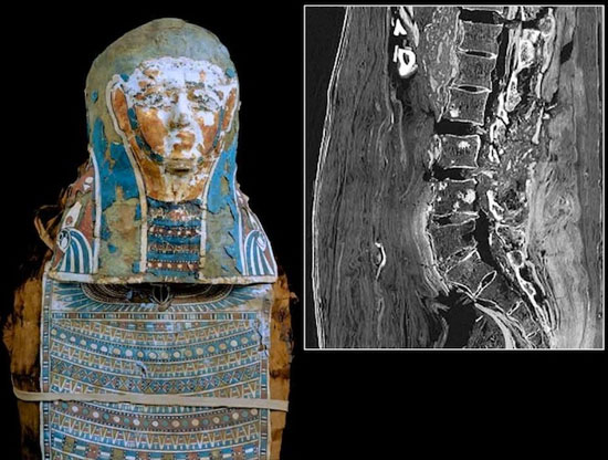 Ancient people also have cancer