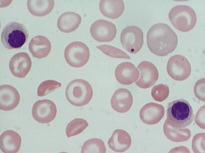Anemia