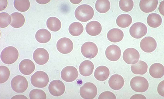 Announcing method to reverse leukemia