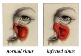 Antibiotics are prescribed too often for sinusitis