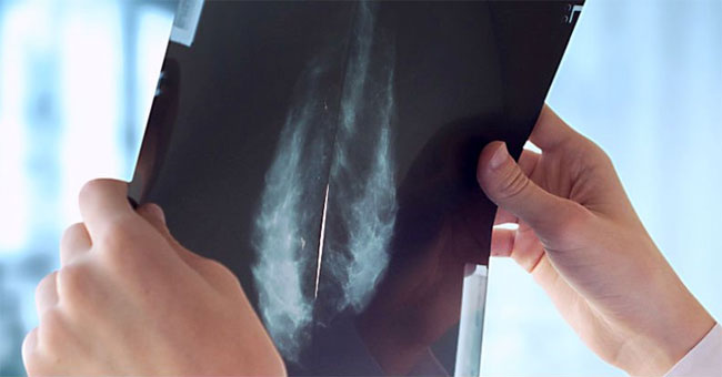 Anti-osteoporosis drugs can inhibit breast cancer