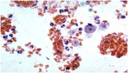 Appeared amoeba eats human brain