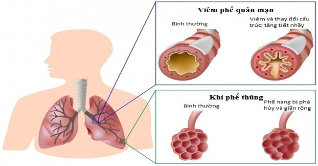 Application of stem cells in the treatment of chronic obstructive pulmonary disease