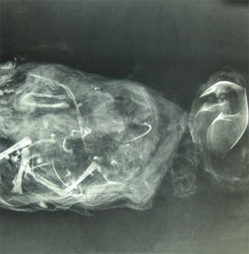 Archeology of fetal remains reveals medieval abortion methods