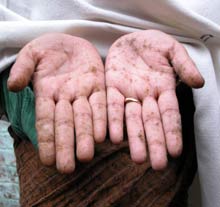 Arsenic can be fatal after 20 years