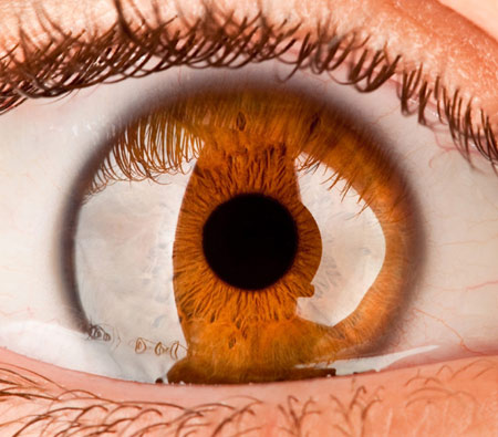 Artificial cornea was born