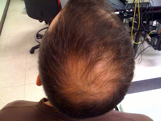 Artificial hair follicles help treat hair loss