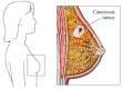 Artificial light develops breast cancer