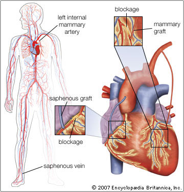Asian women are at risk of arterial defects