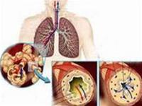 Asthma - things to know