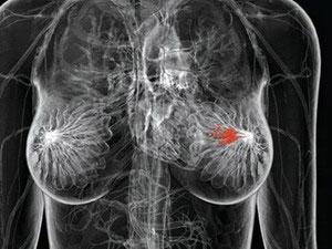 ATM genetic testing helps predict breast cancer