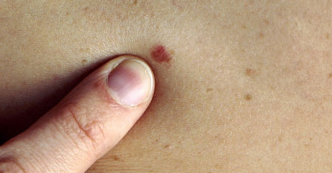 Australia developed a method for rapid diagnosis of skin cancer