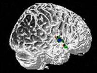 Autism affects the whole brain
