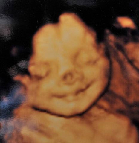 Baby girl born with circus clown nose