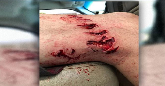 'Bacteria eat humans' after being bitten by sharks