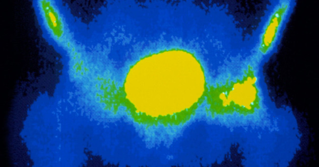 Bacteria from the ocean floor help treat prostate cancer