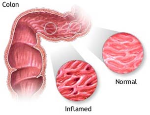 Bacteria in cow's milk cause Crohn's intestinal disease