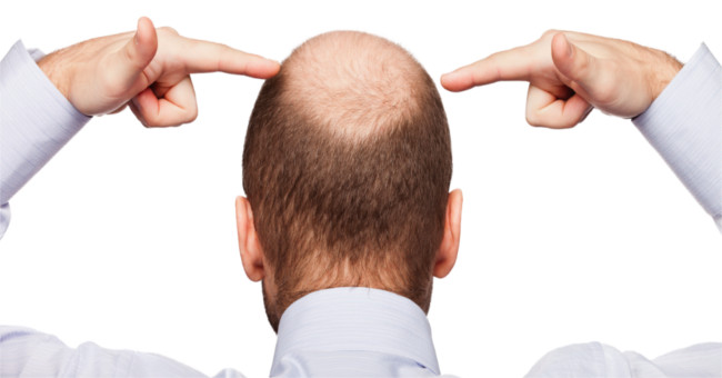 Baldness: Causes and symptoms