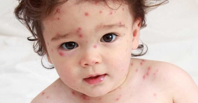 Be wary of chickenpox during the season
