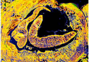 Be wary of lung fluke