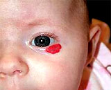 Benign hemangiomas but also cause complications