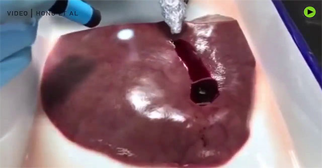 'Bio-glue' helps visceral injuries stop bleeding